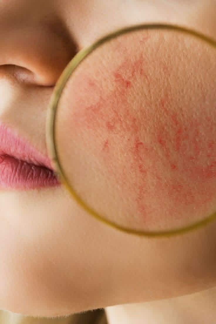 Inflacure terápia - rosaceás bőr kezelés